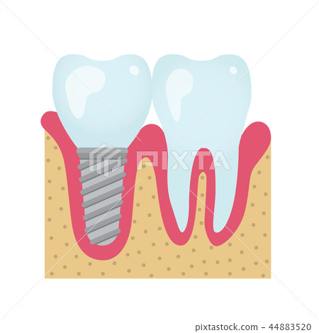 Dental crowns and implantation 44883520