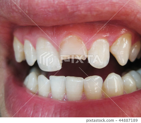 Broken tooth. Broken upper incisor in a man mouth. 44887189