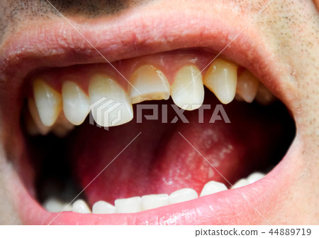 Broken tooth. Broken upper incisor in a man mouth. 44889719