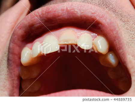 Broken tooth. Broken upper incisor in a man mouth. Broken tooth. Broken upper incisor in a man mouth. 44889735