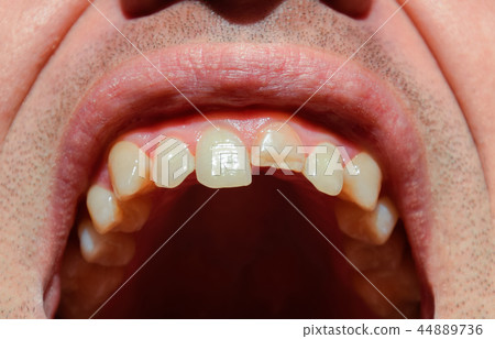 Broken tooth. Broken upper incisor in a man mouth. Broken tooth. Broken upper incisor in a man mouth. 44889736