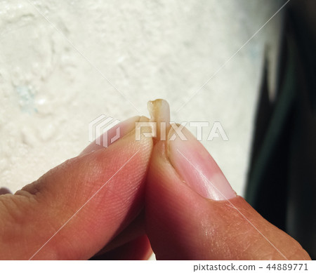 Fallen off old filling with a cutter. The seal of the tooth. 44889771