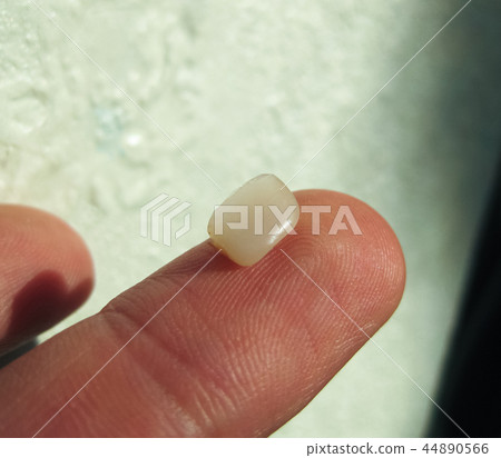 Fallen off old filling with a cutter. The seal of the tooth. 44890566
