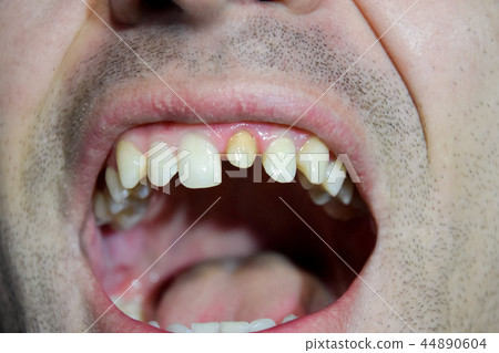 The process of replacing a tooth. Preparation of the tooth under the crown. Pin in the tooth. The process of replacing a tooth. Preparation of the tooth under the crown. Pin in the tooth. 44890604