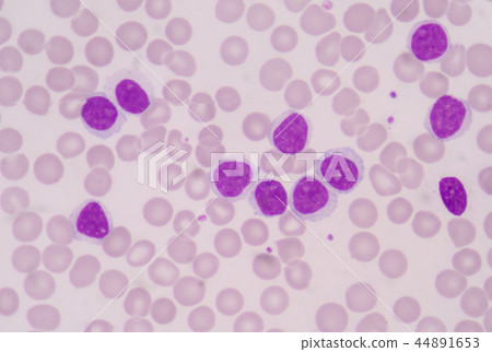 bone marrow makes abnormal myeloblasts 44891653