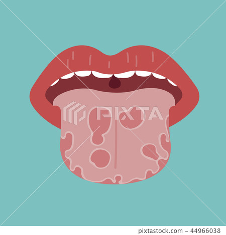 Tongue disease, vector of organ concept. Tongue disease, vector of organ concept. 44966038