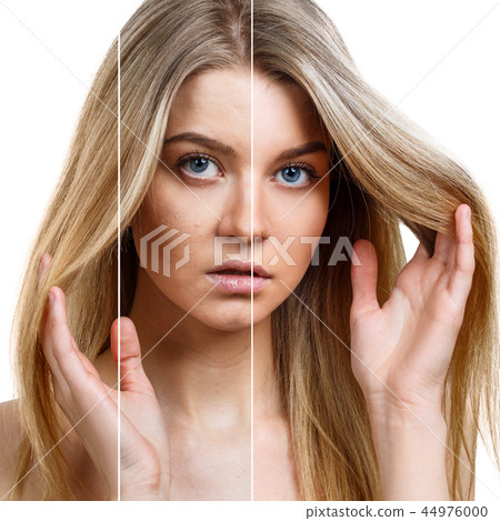 Woman face with part with acne before and after make-up. 44976000