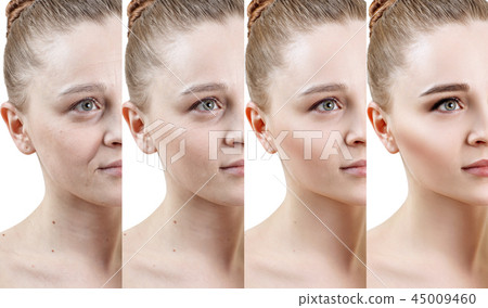 Woman with phase of skin rejuvenation before and after treatment. 45009460