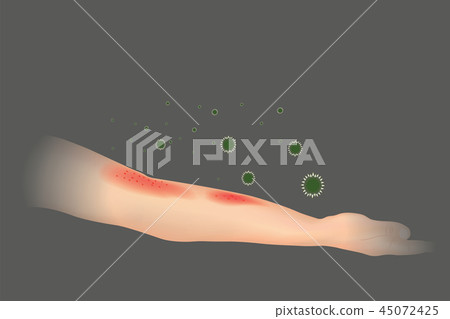 Skin allergy. The appearance of rash in the arm. Skin allergy. The appearance of rash in the arm. 45072425