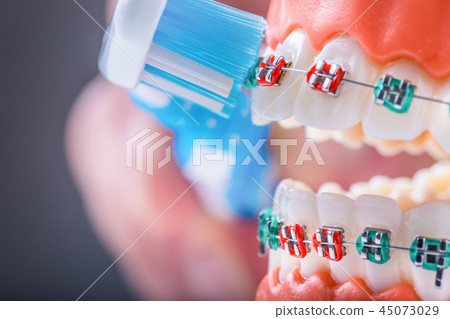 Close-up teeth braces and tooth brush. Close-up teeth braces and tooth brush. 45073029