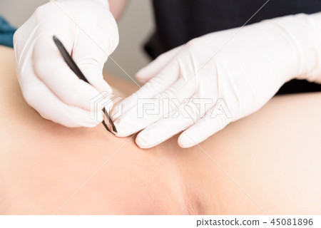Hair removal, wax hair removal, delicate zone, groin, treatment, tweezers, natural light, image 45081896