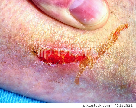 Fresh bloody place in skin. Nasty looking bruise Fresh bloody place in skin. Nasty looking bruise 45152821