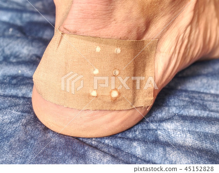 Mediciman treat damaged skin on sportsman heel 45152828