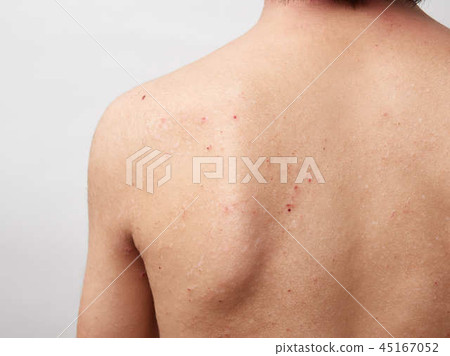 Atopic, dry skin, dermatitis image of a child Atopic, dry skin, dermatitis image of a child 45167052