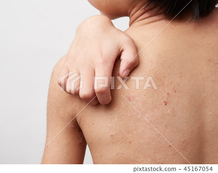 Atopic, dry skin, dermatitis image of a child 45167054