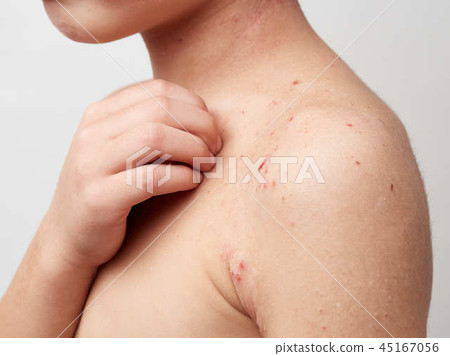 特應性,皮膚乾燥,兒童皮炎的形象 特應性,皮膚乾燥,兒童皮炎的形象 45167056