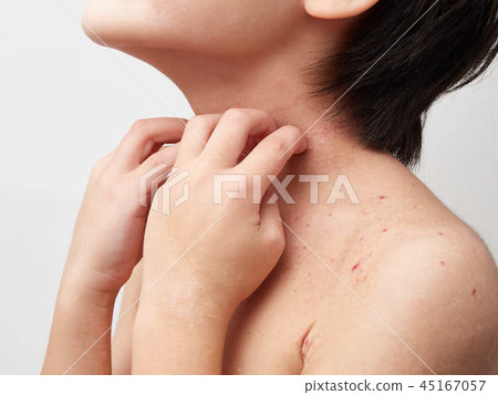 特應性，皮膚乾燥，兒童皮炎的形象 45167057