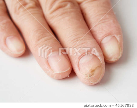 粗糙的手,洗滌劑皮疹,腳趾甲(指甲)圖像 粗糙的手,洗滌劑皮疹,腳趾甲(指甲)圖像 45167058
