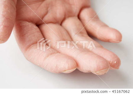 粗糙的手，洗滌劑皮疹，腳趾甲（指甲）圖像 45167062