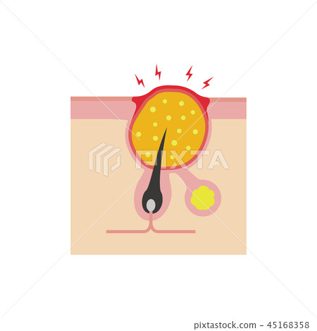 Cutaneous skin sectional view Acne progress illustration / Yellow acne (Pisces acne) 45168358
