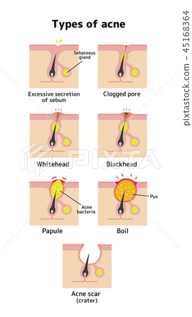 痤瘡和症狀的主要類型插圖(英語) 痤瘡和症狀的主要類型插圖(英語) 45168364