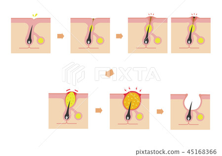 Main types of acne and progression of symptoms Illustrations (without letters) Main types of acne and progression of symptoms Illustrations (without letters) 45168366