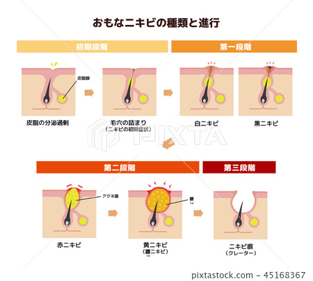 Main types of acne and progression of symptoms Illustration (Japanese) Main types of acne and progression of symptoms Illustration (Japanese) 45168367