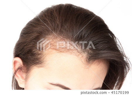 Woman serious hair loss problem for health care Woman serious hair loss problem for health care 45170199