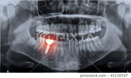 Roentgen teeth upper and lower jaw 45216597