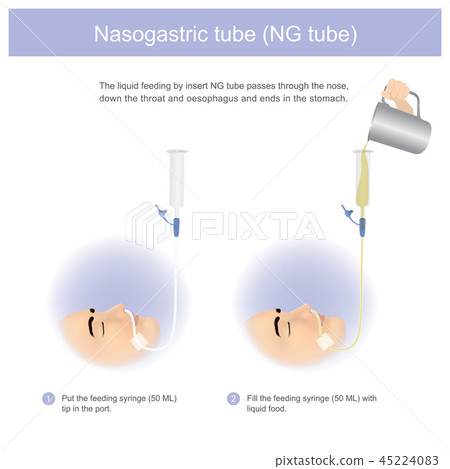 Nasogastric tube. Nasogastric tube. 45224083