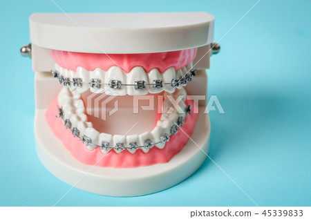 tooth model with metal wire dental braces. 45339833