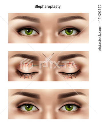 Blepharoplasty Suture Stitches Composition 45420572