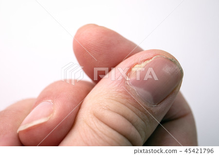 Close up of nail fungus infection on the thumb finger Close up of nail fungus infection on the thumb finger 45421796