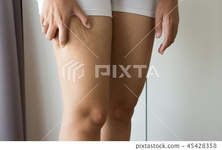 Woman with cellulitis on leg excess and overweight Woman with cellulitis on leg excess and overweight 45428358