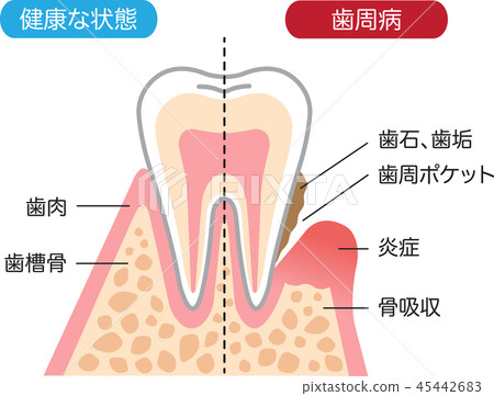 牙周病和健康的牙齒截面 牙周病和健康的牙齒截面 45442683