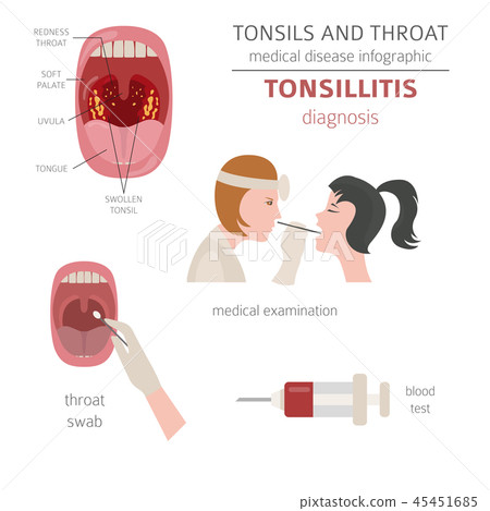 Tonsils and throat diseases. Tonsillitis  45451685