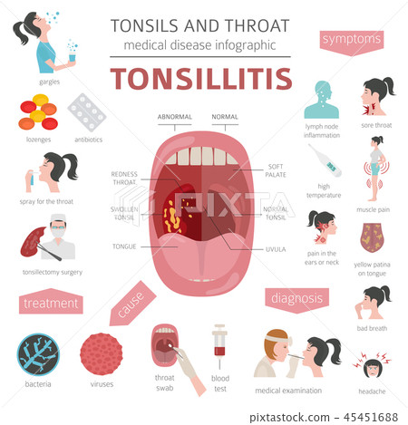 Tonsils and throat diseases. Tonsillitis Tonsils and throat diseases. Tonsillitis 45451688