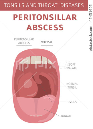 Tonsils and throat diseases. Peritonsillar abscess Tonsils and throat diseases. Peritonsillar abscess 45451695