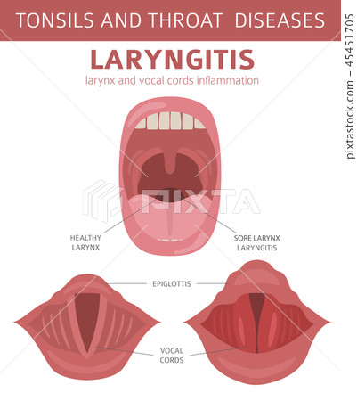 Tonsils and throat diseases. Laryngitis  45451705