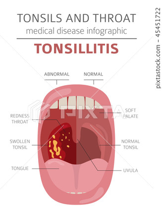 Tonsils and throat diseases. Tonsillitis  45451722