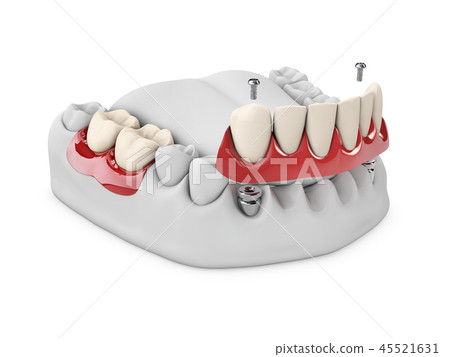 teeth and dental implant in jaw bone 45521631
