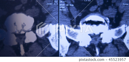 Medical hips spine pelvis MRI scan Medical hips spine pelvis MRI scan 45523957