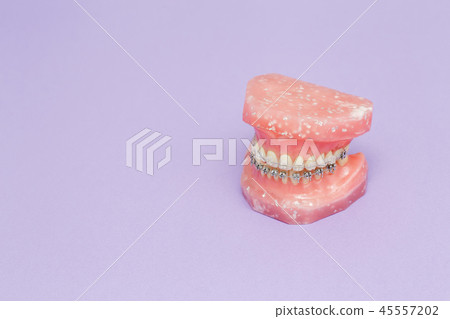 Human jaw or teeth model with metal dental braces Human jaw or teeth model with metal dental braces 45557202