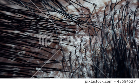 Hair scalp with dandruff and scaly from psoriasis 45584527