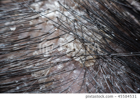 Hair scalp with dandruff and scaly from psoriasis Hair scalp with dandruff and scaly from psoriasis 45584531