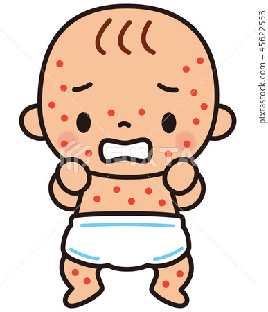 Baby who got eczema - Stock Illustration [45622553] - PIXTA