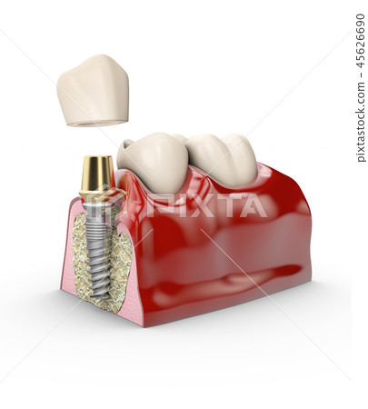 jaw model tooth implant jaw model tooth implant 45626690