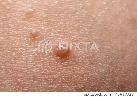 Close up of Molluscum Contagiosum also called water wart 45657328