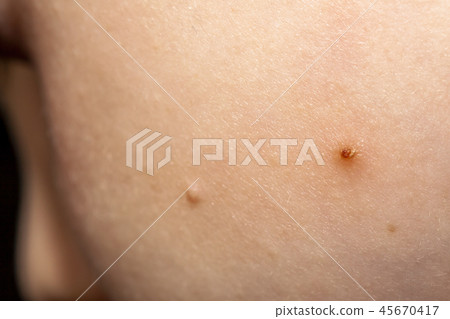 Close up of Molluscum Contagiosum also called water wart 45670417