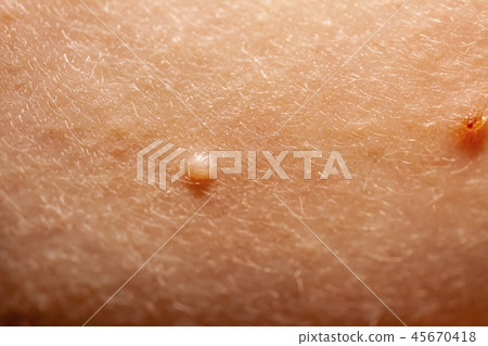Close up of Molluscum Contagiosum also called water wart 45670418